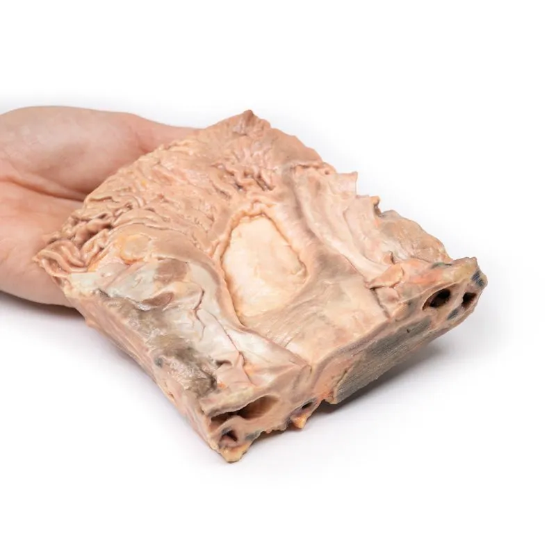3D Printed Chronic Gastric Ulcer